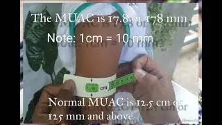 IMCI: Measuring Mid Upper Arm Circumference (MUAC)