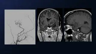 Pterional Craniotomy and EAC for Resection of a Clinoidal Meningioma with STA-MCA Bypass