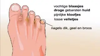 Voetschimmel - Symptomen en behandeling