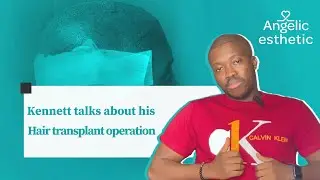 Kennett talks about his Hair transplant operation with Angelic esthetic