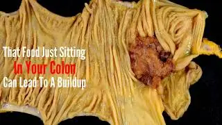 Colon Cleanse At Home; 3 Home Remedies For Colon Cleansing