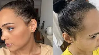 MINOXIDIL FAZ CAIR CABELO? 1 MÊS USANDO MINOXIDIL PARA ENTRADA