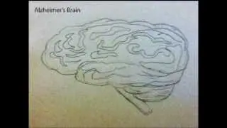 Alzheimer's Disease