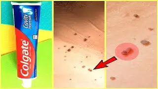 REMOVE SKIN TAGS OVERNIGHT WITH ONION & COLGATE| HOW TO REMOVE SKIN TAG | SKIN TAG REMOVAL