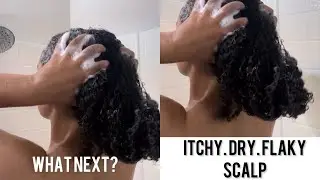 HAIR DIARIES ep.3 | Getting Rid of Dry Scalp, Danduff and Redness