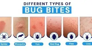 #186 INSECT STING OR BITE: WHAT SHOULD YOU DO? #Insectsting #bugbites  #firstaid  🐜🦟🩹🚑😣