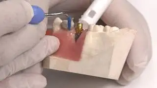 V2391 Diagnosis and Treatment of Failing Implants