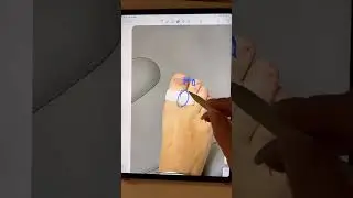 Онихолизис это не болезнь подология