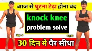 Knock Knee Exercise at Home |🦵 30 दिन मे पैर सीधा ✅ | How To Fix Knock Knees 2026