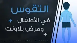علاج تقوس الساقين فى الاطفال بدون جراحه