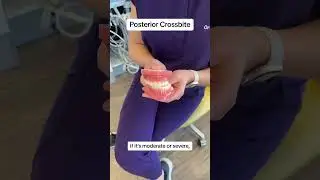 Unlock Your Child's Best Smile: Fixing Posterior Crossbites Explained