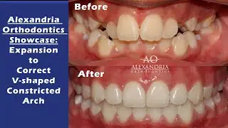Alexandria Orthodontics Showcase:  Arch expansion for crowding