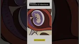 # Process of Abortion 💉💊