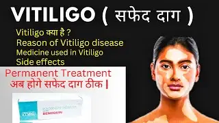 Vitiligo (सफेद दाग) का इलाज|| Vitiligo Treatment|| Monobenzone Cream Use||@asadpharmacy