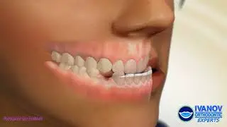 How to fix Underbite with Braces
