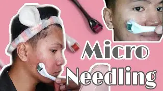 MICRO NEEDLING FOR ACNE SCARS AND MARKS | My Derma Roller Experience