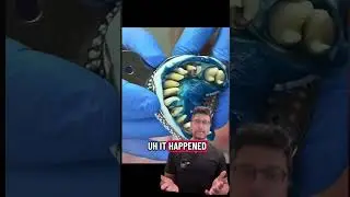 Teeth 🦷 pulled out with Impression?! #dentist #braces #teeth