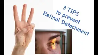 3 tips to prevent retinal detachment/ #retinaldetachment