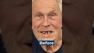 Before and After Nuvia's Permanent Teeth in 24-Hours! 🎉