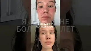 Продолжение в следующей части💛 #акне #skincare #skincareroutine #acne