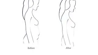 Abdominoplasty - Tummy Tuck Information by Indianapolis Plastic Surgeon Dr. Ashley Robey