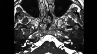Abducens Nerve Palsy