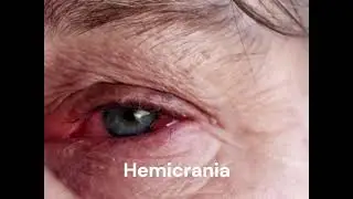 Hemicrania