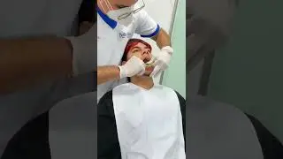 Impresi&oacute;n superior en alginato, es una impresi&oacute;n precisa de los dientes y las enc&iacute;as