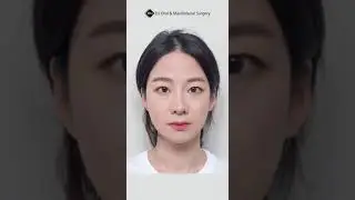 Korean Double Jaw + Vline + Cheekbone Reduction Surgery Results | (Before & After) #shorts