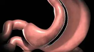 Sleeve Gastrectomy Animation :: Ken Wong Weight Loss Australia
