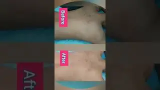 Back Bleaching Before & After | See Results #bleach #bleaching #face #shorts