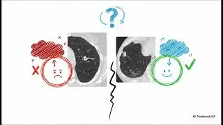 Precision First: Correct Application of Lung-RADS v2022 Category 0 in Lung Cancer Screening