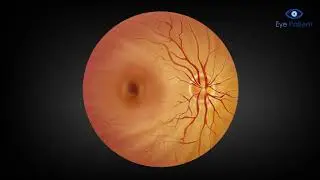 Cystoid Macular Edema- Medication Injection