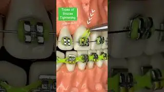Braces Tightening ,Orthodontics treatments