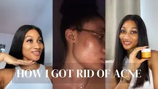 My go to acne products + Clean and Clear, Fenty Skin, OleHenriksen, The Ordinary, Garnier review