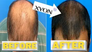 XYONHEALTH Topical Finasteride BETTER! Then Propecia-Dr. Hasson