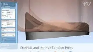 OrthoMODEL 2015 - Forefoot Posts (Extrinsic and Intrinsic)