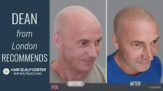 Dean's testimonial on how his SMP treatment at Hair Scalp Center in Bangkok changed his life