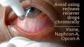 Avoid using redness reliever drops chronically