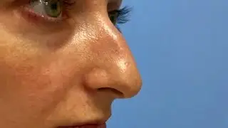До и после ринопластики