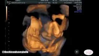 19 WEEK 3D TWIN Ultrasound!! VERY ACTIVE BABIES!!