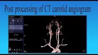 post processing of  CT carotid angiogram