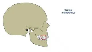 OCCLUSION IN FPD online video cutter com