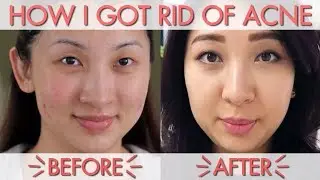 How My Skin Cleared Up!