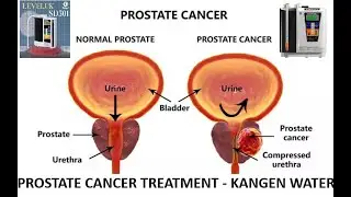 PROSTATE CANCER TREATMENT :- KANGEN WATER.
