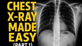 Chest X-Ray Made Easy (Part 1) &mdash; The ONLY Guide You&rsquo;ll Ever Need!