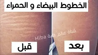 لن تصدقى أن هذه الخلطات  ستخلصك من الخطوط البيضاء  والحمراء بالجسم سريعا
