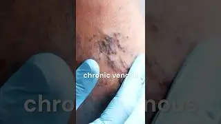 Can my leg ulcer be healed?