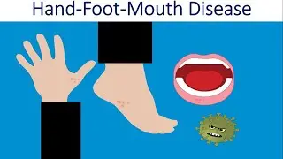 What is Hand, Foot & Mouth Disease | HFMD | Cause, Symptoms, Diagnosis & Prevention of HFMD