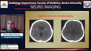 Differential diagnosis for bilateral abnormalities of the basal ganglia and thalamus.